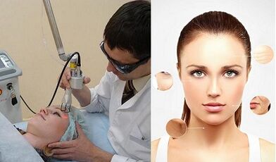 Bagaimana peremajaan kulit dengan laser dilakukan